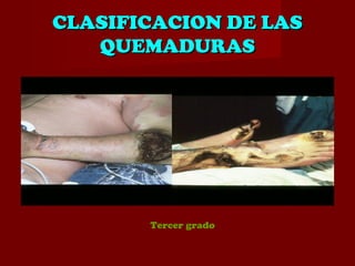 CLASIFICACION DE LASCLASIFICACION DE LAS
QUEMADURASQUEMADURAS
Tercer grado
 