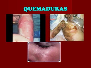 QUEMADURASQUEMADURAS
 