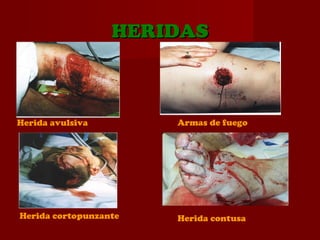 HERIDASHERIDAS
Herida avulsiva Armas de fuego
Herida contusaHerida cortopunzante
 