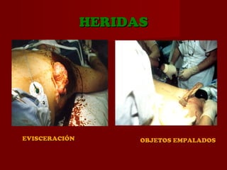 HERIDASHERIDAS
OBJETOS EMPALADOSOBJETOS EMPALADOSEVISCERACIÓNEVISCERACIÓN
 