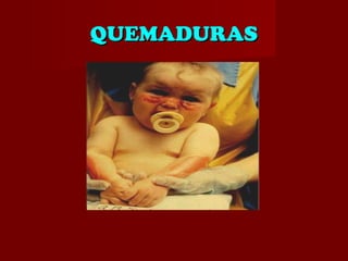 QUEMADURASQUEMADURAS
 