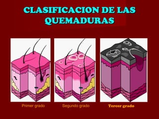 CLASIFICACION DE LASCLASIFICACION DE LAS
QUEMADURASQUEMADURAS
Primer grado Segundo grado Tercer grado
 