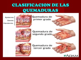 CLASIFICACION DE LASCLASIFICACION DE LAS
QUEMADURASQUEMADURAS
 