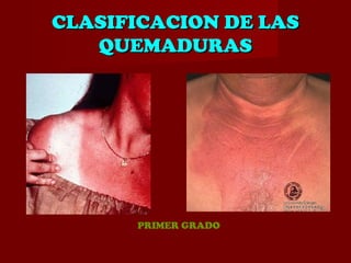 CLASIFICACION DE LASCLASIFICACION DE LAS
QUEMADURASQUEMADURAS
PRIMER GRADO
 