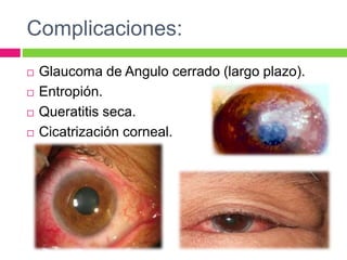 Complicaciones:
 Glaucoma de Angulo cerrado (largo plazo).
 Entropión.
 Queratitis seca.
 Cicatrización corneal.
 