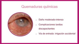 Quemaduras oculares | PPTX