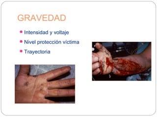 GRAVEDAD
Intensidad y voltaje
Nivel protección víctima
Trayectoria
 