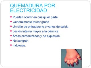 QUEMADURA POR
ELECTRICIDAD
Pueden ocurrir en cualquier parte
Generalmente tercer grado
Un sitio de entrada/uno o varios de salida
Lesión interna mayor a la dérmica.
Áreas carbonizadas y de explosión
No sangran
Indoloras.
 
