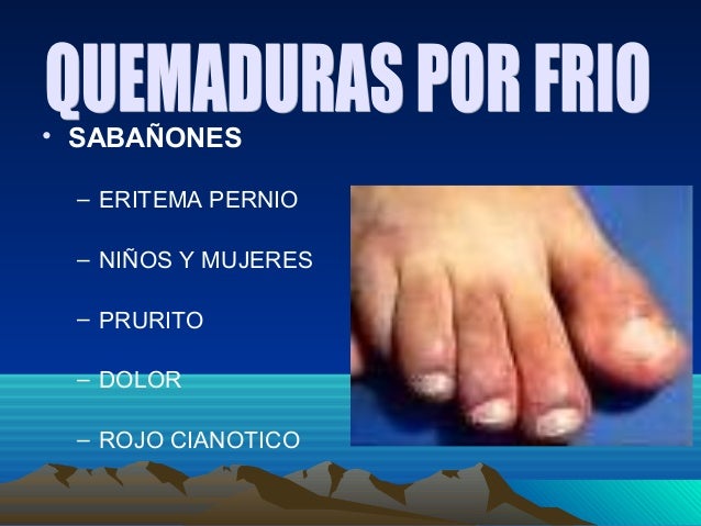 Flebolog con la salida