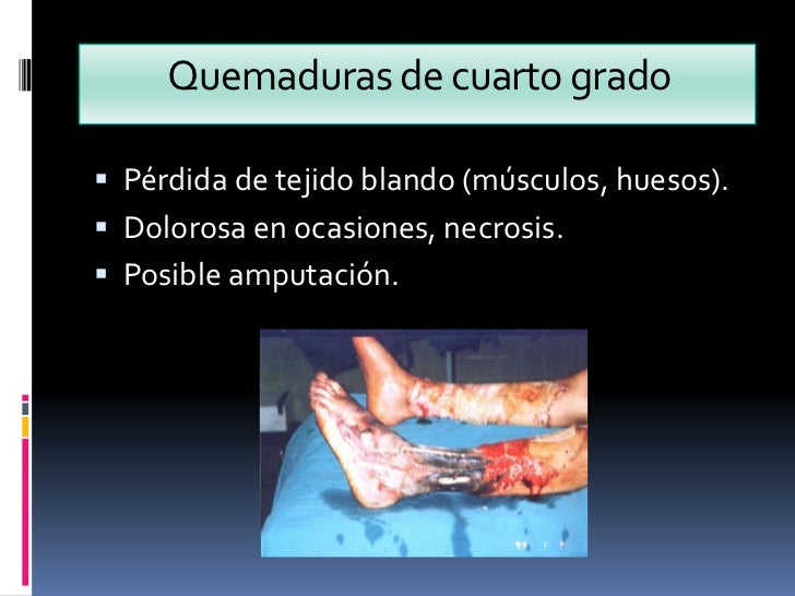 Quemaduras por profundidad Quemaduras por profundidad