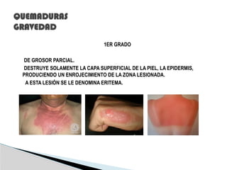 Tipos de Quemaduras químicas en el trabajo. | PPTX