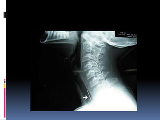 Quemaduras y cuerpos extraños