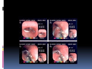Quemaduras y cuerpos extraños