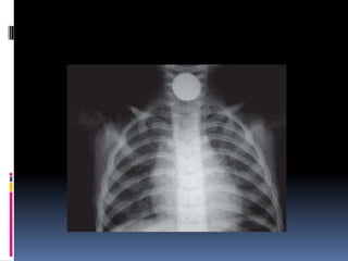 Quemaduras y cuerpos extraños