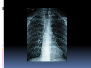 Quemaduras y cuerpos extraños