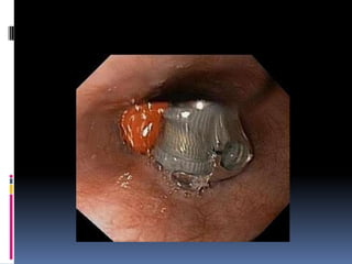 Quemaduras y cuerpos extraños