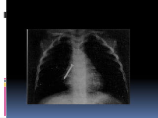 Quemaduras y cuerpos extraños