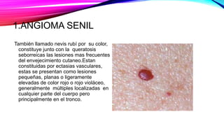 1.ANGIOMA SENIL
También llamado nevis rubí por su color,
constituye junto con la queratosis
seborreicas las lesiones mas frecuentes
del envejecimiento cutaneo.Estan
constituidas por ectasias vasculares,
estas se presentan como lesiones
pequeñas, planas o ligeramente
elevadas de color rojo o rojo violáceo,
generalmente múltiples localizadas en
cualquier parte del cuerpo pero
principalmente en el tronco.
 