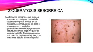2.QUERATOSIS SEBORREICA
Son lesiones benignas, que pueden
aparecer en cualquier parte de la
superficie corporal menos en las
mucosas, son frecuentes en cara y
tronco únicas o múltiples
generalmente de color pigmentado
oscuro, superficie algo irregular de
tamaño variable. Comienzan como
una mancha pigmentada y luego se
torna mas oscura y se hace placa.
 