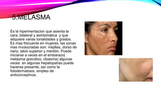 5.MELASMA
Es la hipermentacion que asienta la
cara, bilateral y asintomática y que
adquiere varias tonalidades y grados.
Es mas frecuente en mujeres, las zonas
mas involucradas son: mejillas, dorso de
nariz, labio superior y mentón. Puede
iniciarse a veces en el embarazo(
melasma gravídico, cloasma) algunas
veces en algunas hepatopatías puede
hacerse presente, así como la
fotodermatosis, empleo de
anticonceptivos.
 