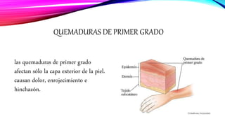 QUEMADURAS DE PRIMER GRADO
las quemaduras de primer grado
afectan sólo la capa exterior de la piel.
causan dolor, enrojecimiento e
hinchazón.
 