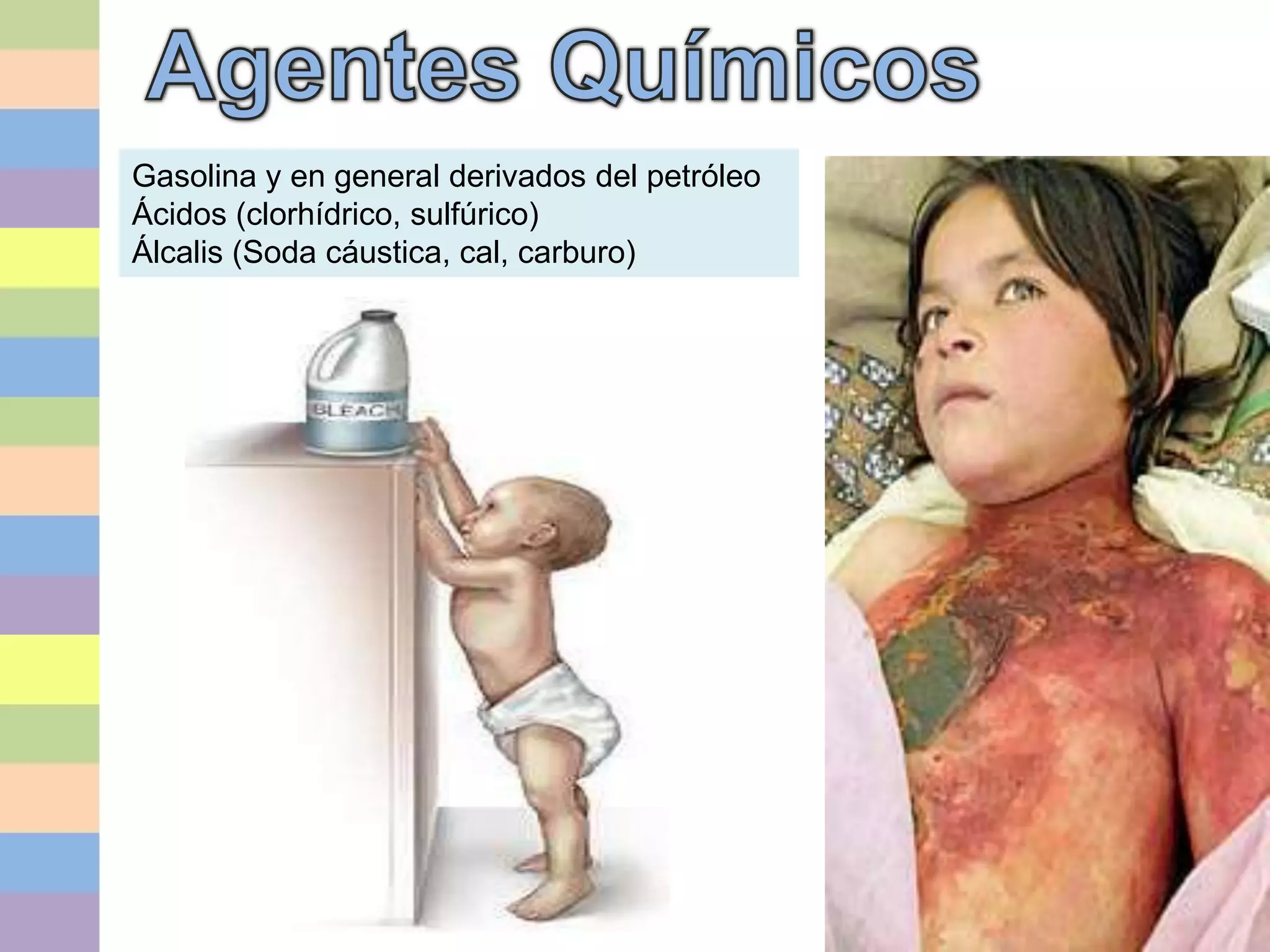 Quemado pediatrico cuidados de enfermeria | PPTX | Skin and Dermatology