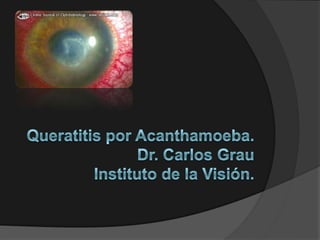 Queratitis por Acanthamoeba.Dr. Carlos GrauInstituto de la Visión. 