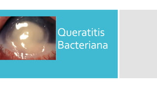 Queratitis
Bacteriana
 
