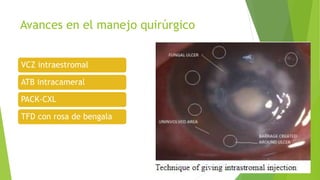 Avances en el manejo quirúrgico
VCZ intraestromal
ATB intracameral
PACK-CXL
TFD con rosa de bengala
 