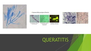 QUERATITIS
 