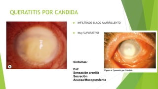 QUERATITIS POR CANDIDA
 INFILTRADO BLACO AMARRILLENTO
 Muy SUPURATIVO
Síntomas:
D+F
Sensación arenilla
Secreción
Acuosa/Mucopurulenta
 