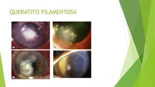 QUERATITIS FILAMENTOSA
 