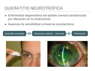 QUERATITIS NEUROTRÓFICA
➤ Enfermedad degenerativa del epitelio corneal caracterizada
por alteración en la cicatrización.
➤ Ausencia de sensibilidad corneal es característica.
Queratitis punteada Ulceración epitelial… estromal Perforación