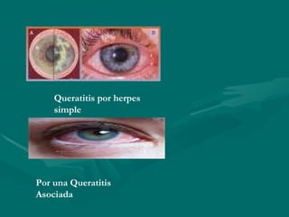 Queratitis por herpes simple   Por una Queratitis Asociada   