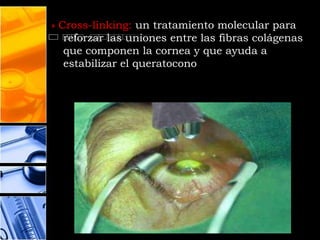 » Cross-linking: un tratamiento molecular para
   reforzar las uniones entre las fibras colágenas
   que componen la cornea y que ayuda a
   estabilizar el queratocono
 