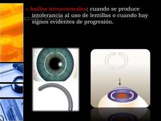 » Anillos intracorneales: cuando se produce
   intolerancia al uso de lentillas o cuando hay
   signos evidentes de progresión.
 