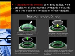 • » Trasplante de córnea: es el más radical y se
  emplea en el queratocono avanzado y cuando
  las otras opciones no pueden ofrecer mejoría.
 