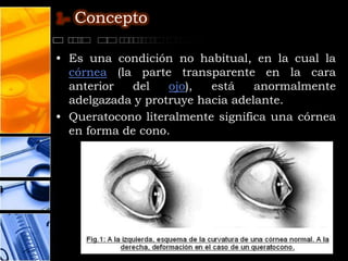 1- Concepto

• Es una condición no habitual, en la cual la
  córnea (la parte transparente en la cara
  anterior  del    ojo),  está    anormalmente
  adelgazada y protruye hacia adelante.
• Queratocono literalmente significa una córnea
  en forma de cono.
 