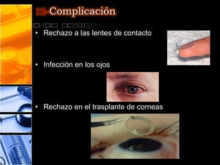 12-Complicación

• Rechazo a las lentes de contacto



• Infección en los ojos




• Rechazo en el trasplante de corneas
 