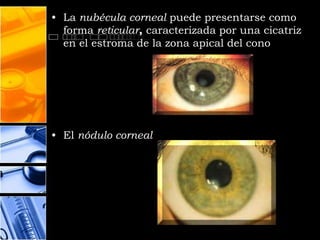 • La nubécula corneal puede presentarse como
  forma reticular, caracterizada por una cicatriz
  en el estroma de la zona apical del cono




• El nódulo corneal
 
