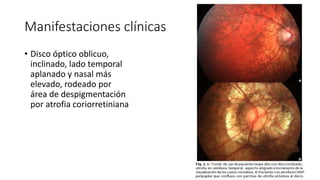 Manifestaciones clínicas 
• Disco óptico oblicuo, 
inclinado, lado temporal 
aplanado y nasal más 
elevado, rodeado por 
área de despigmentación 
por atrofia coriorretiniana 
 
