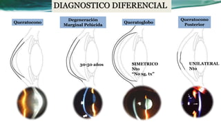 Queratocono
Posterior
Queratoglobo
Degeneración
Marginal Pelúcida
Queratocono
DIAGNOSTICO DIFERENCIAL
UNILATERAL
Nto
SIMETRICO
Nto
“No sg, tx”
30-50 años
 