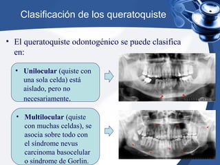 Clasificación de los queratoquiste
• El queratoquiste odontogénico se puede clasifica
en:
• Multilocular (quiste
con muchas celdas), se
asocia sobre todo con
el síndrome nevus
carcinoma basocelular
o síndrome de Gorlin.
• Unilocular (quiste con
una sola celda) está
aislado, pero no
necesariamente.
 