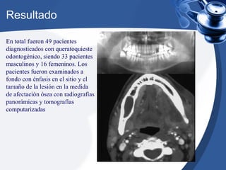 Resultado
En total fueron 49 pacientes
diagnosticados con queratoquieste
odontogénico, siendo 33 pacientes
masculinos y 16 femeninos. Los
pacientes fueron examinados a
fondo con énfasis en el sitio y el
tamaño de la lesión en la medida
de afectación ósea con radiografías
panorámicas y tomografías
computarizadas
 