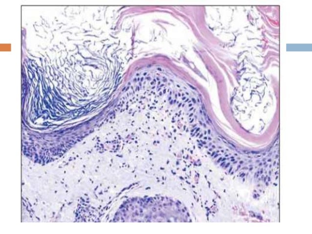 Queratosis actinica