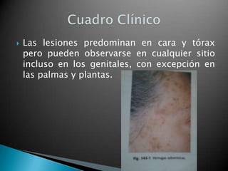    Las lesiones predominan en cara y tórax
    pero pueden observarse en cualquier sitio
    incluso en los genitales, con excepción en
    las palmas y plantas.
 