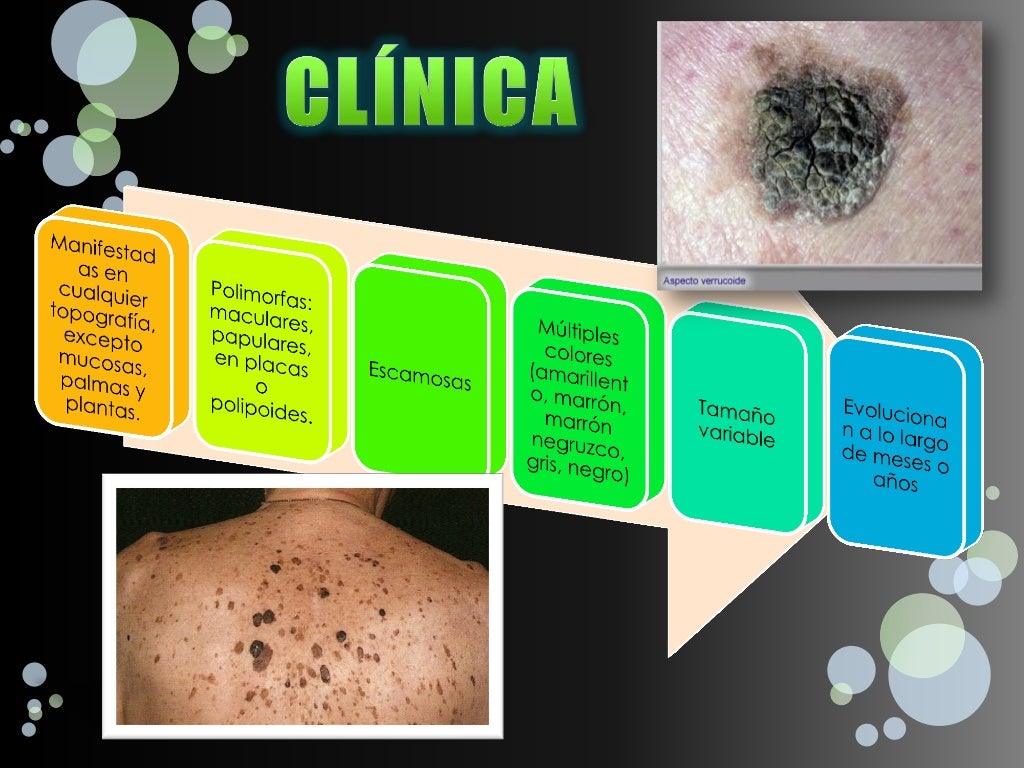 Queratosis seborreica