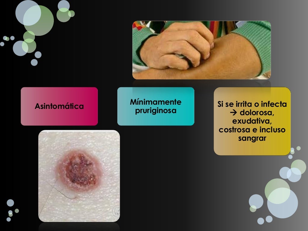 Queratosis seborreica