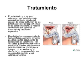 Tratamiento El tratamiento que es más adecuado para usted depende principalmente del estadio del cáncer, del grado del tumor, de los síntomas que usted experimenta y de su salud en general. El médico le describirá sus opciones de tratamiento y resultados esperados.  Usted debe tomar en cuenta tanto los beneficios esperados como los posibles efectos secundarios de cada opción de tratamiento. Tal vez usted querrá consultar con su médico los posibles efectos sobre la actividad sexual. Usted puede trabajar con su médico en el diseño de un plan que refleje sus necesidades médicas y sus valores personales.  