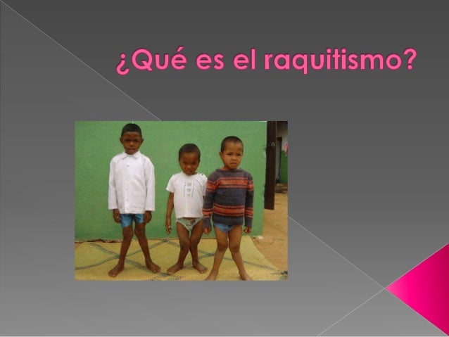 Qué es el raquitismo